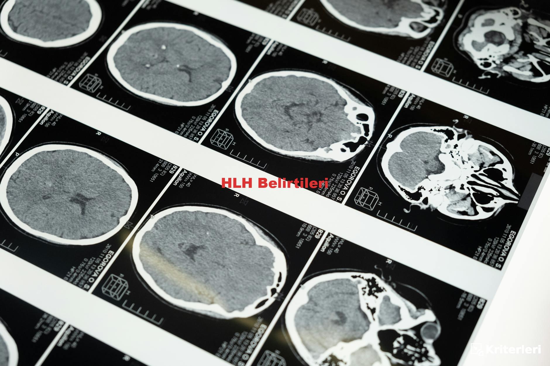 HLH Belirtileri